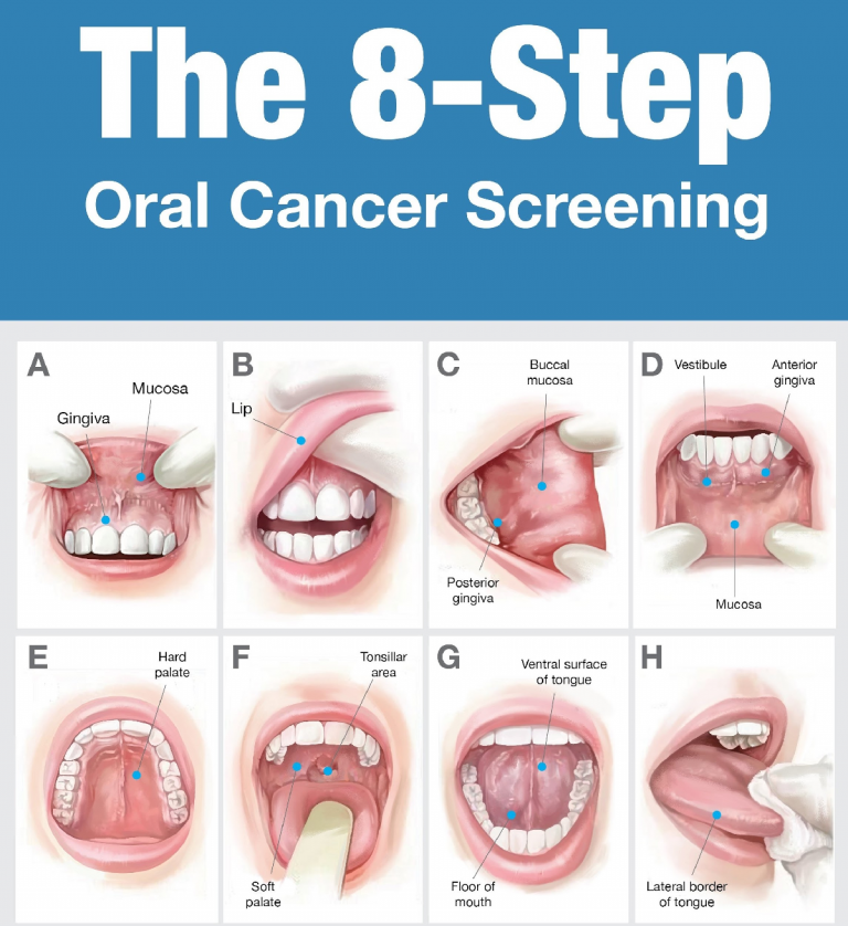 Oral Cancer Screenings - Exton Family Dentist