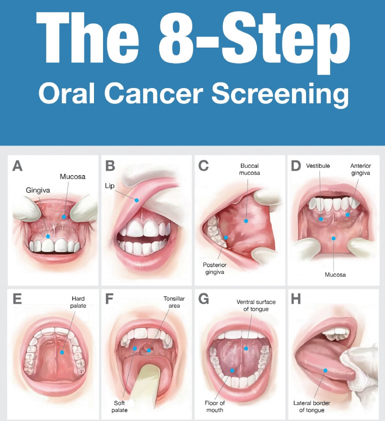 oral-cancer-screenings-exton-family-dentist